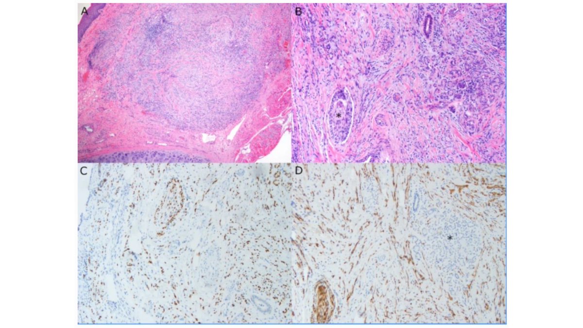 *Along with researchers from <a href="/VUmedicine/">Vanderbilt School of Medicine</a> &amp;@VUMCMolecPath, <a href="/MdMadelyn/">Madelyn Stevens</a> <a href="/TopfHNS/">Michael Topf MD, MSCI</a> reported on a case of the exceedingly rare nasal mucosal desmoplastic melanoma and reviewed the literature surrounding such cases. #Melanoma #Pathology #MedTwitter link.springer.com/article/10.100…