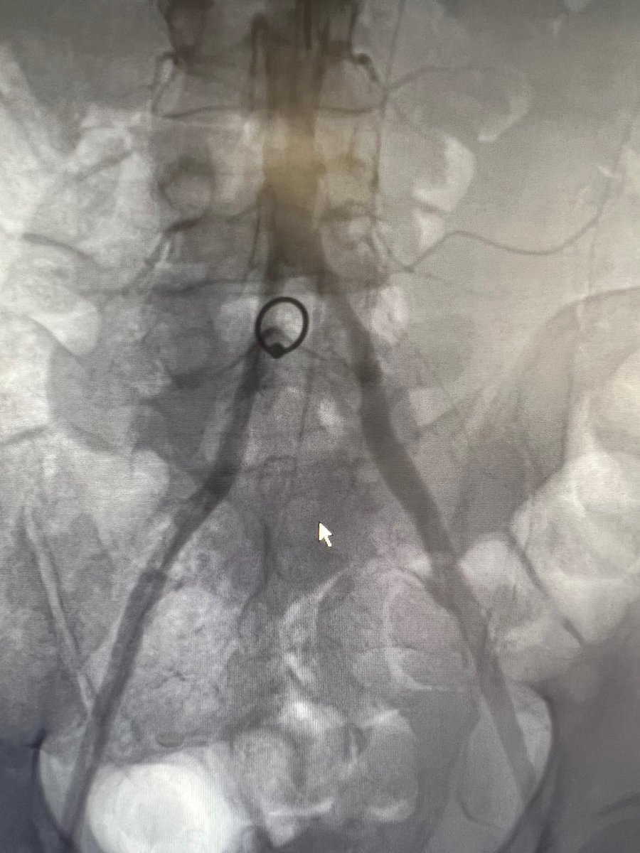 A nice reminder that the aortic bifurcation is at the level of the umbilicus. #AortaEd