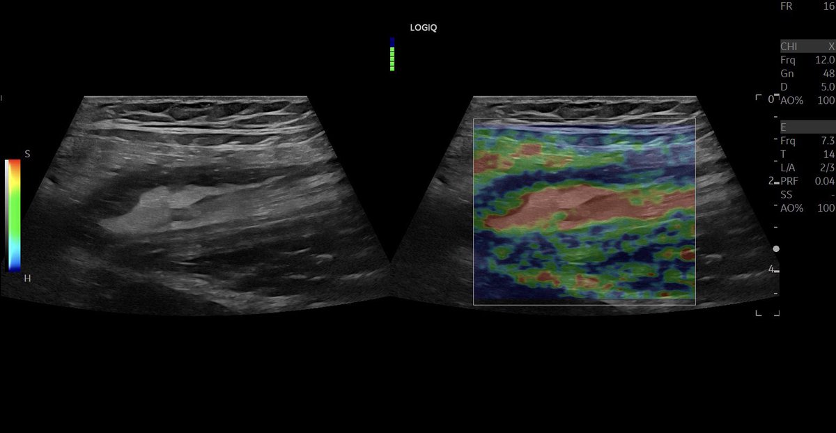 #muscleinjury of a football player during free kick of the #rectusfemoris indirect tendon!! #footballinjury #tendoninjury #mskus #pocus #pocushub #gelogiqe10r2