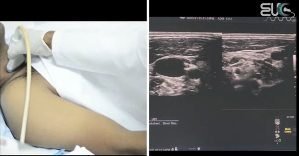 MoDa4's tweet image. Ultrasound of the upper extremity Venous   
مراجعة سريعة 💭
✅ Technique 
✅ anatomy 

من أجمل الفديوهات تختصر لك الكثير وتفهم وتراجع وتسهل عليك فهم أساسيات الفحص مع زميلنا محمد 👍🏼
#ultrasound #sonographer
#Radiology #vascular 

youtu.be/gesaL7eqWpE
youtu.be/3NYdqBnENfg
