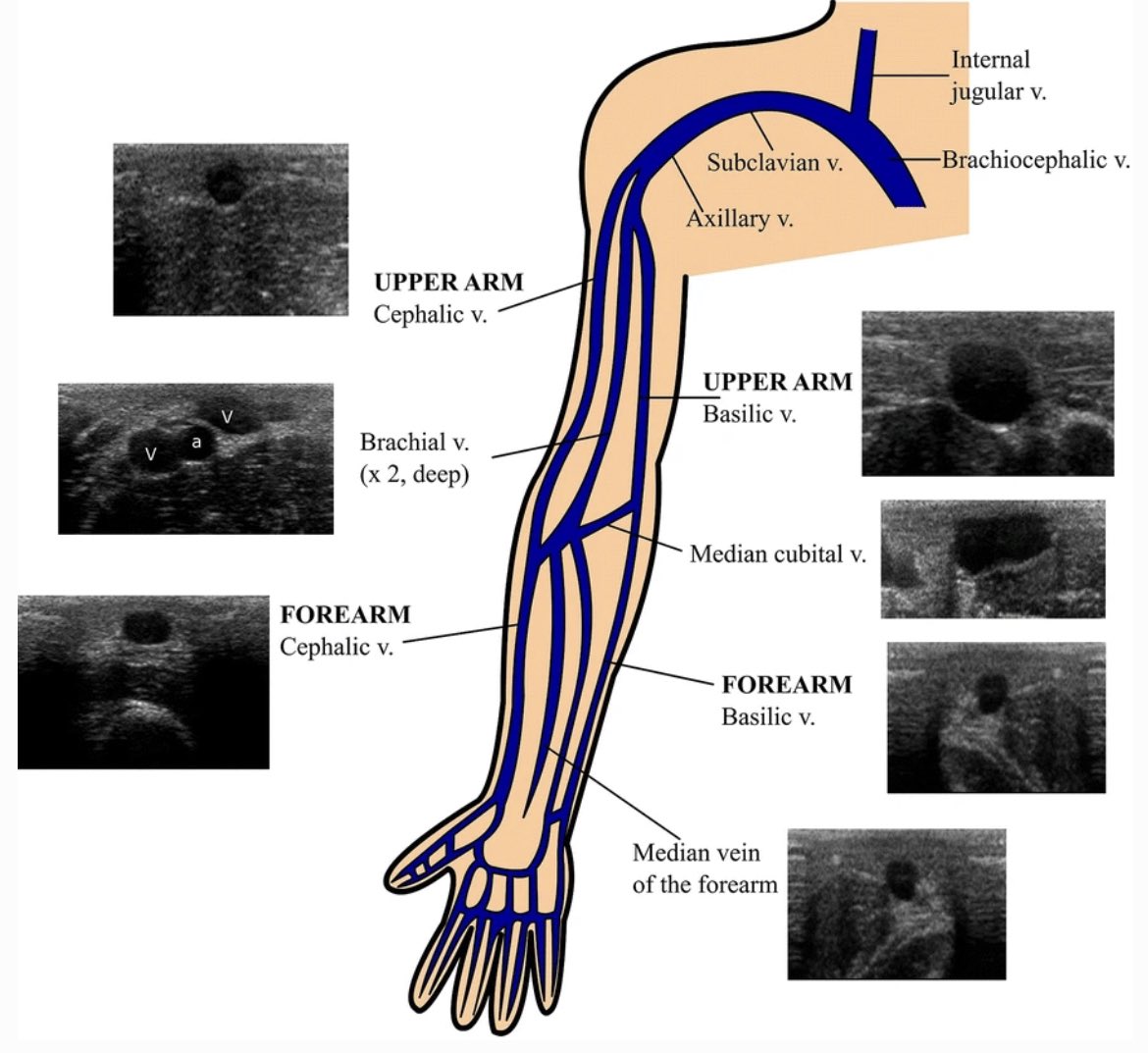 MoDa4's tweet image. Ultrasound of the upper extremity Venous   
مراجعة سريعة 💭
✅ Technique 
✅ anatomy 

من أجمل الفديوهات تختصر لك الكثير وتفهم وتراجع وتسهل عليك فهم أساسيات الفحص مع زميلنا محمد 👍🏼
#ultrasound #sonographer
#Radiology #vascular 

youtu.be/gesaL7eqWpE
youtu.be/3NYdqBnENfg