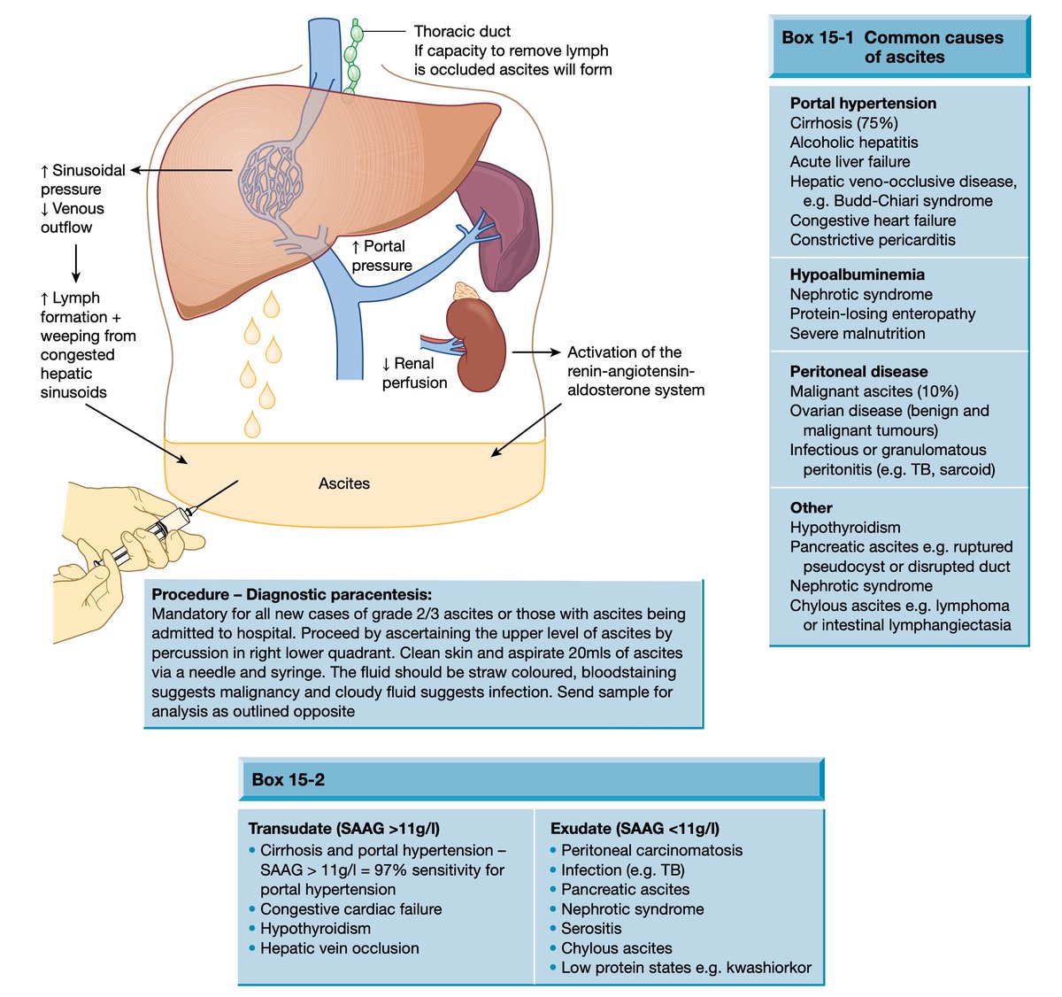 Ascites #4KMedEd #LiverTwitter 

(From Hepatology at a Glance)