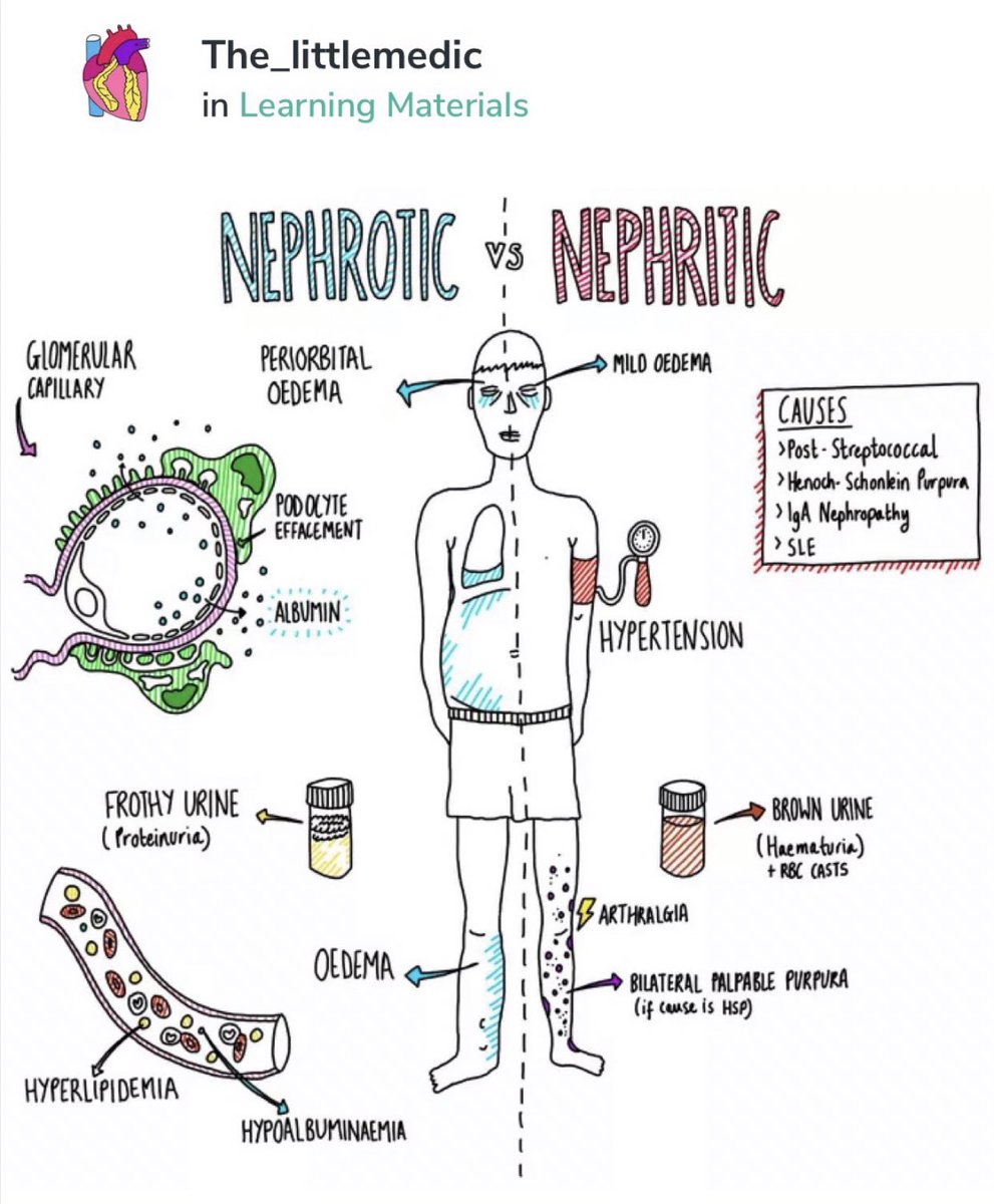 Medical_MD1's tweet photo. Nephritic vs Nephrotic syndrome🧐

Nephr”i”tic
 
👉🏼‘I’nflamation of the glomerular basement membrane 

HEMATURIA(Cola-Coloured urine)

-

Nephr”o”tic

👉🏼Podocyte’s damaged👉🏼Disrupts the glomular charge barrier(Loss of negative charge of GBM)

Massive PROTEINURIA✨

. https://t.co/IDbykfJHej
