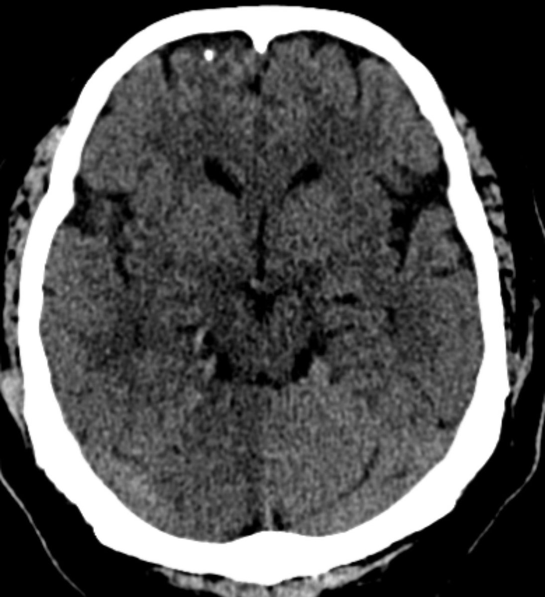 gabeknowz's tweet photo. LKN <4.5h, #hyperdense R P1, and pASPECTS 9. What is you #goto? #neurotwitter #medtwitter https://t.co/kSMNOIrugT