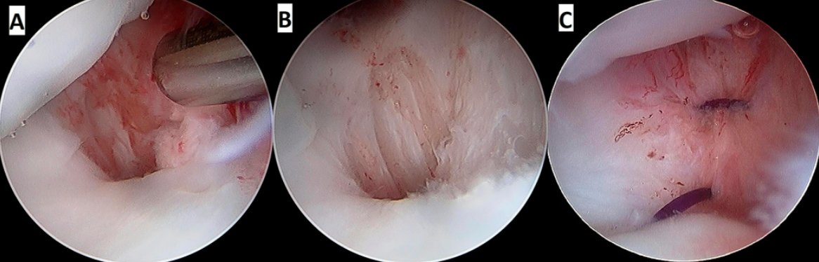J Bone & Joint Surg (@jbjs) on Twitter photo JBJS Reviews Team-Based Approach - Ulnar Wrist Pain in a Tennis Player: Case Review and Discussion
<a href="/MayoClinic/">Mayo Clinic</a> <a href="/sanjkakar/">Sanj Kakar MD</a> <a href="/AnthonyLogliMD/">Anthony L. Logli, M.D.</a>
ow.ly/yY5850IGR95 JBJS Reviews Team-Based Approach - Ulnar Wrist Pain in a Tennis Player: Case Review and Discussion
<a href="/MayoClinic/">Mayo Clinic</a> <a href="/sanjkakar/">Sanj Kakar MD</a> <a href="/AnthonyLogliMD/">Anthony L. Logli, M.D.</a>
ow.ly/yY5850IGR95