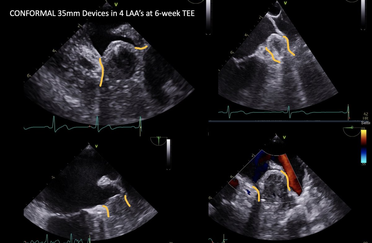 Christopher Ellis (@cellisvandyep) on Twitter photo Had to cheer😎seeing 4 for 4 at 6 week TEE CONFORMAL LAAC Device with 0 leaks🪱, not a whiff of DRT on DAPT only, and 4 totally different LAA shapes sealed off nicely each with a 35mm device!🧽💝 #EPeeps <a href="/adnanalkhouli/">Mohamad Alkhouli</a> <a href="/Drdevignair/">Dr. Devi G Nair</a> <a href="/MCoylewright/">megan coylewright md mph</a> <a href="/AVKaplanMD/">Aaron V. Kaplan</a> Had to cheer😎seeing 4 for 4 at 6 week TEE CONFORMAL LAAC Device with 0 leaks🪱, not a whiff of DRT on DAPT only, and 4 totally different LAA shapes sealed off nicely each with a 35mm device!🧽💝 #EPeeps <a href="/adnanalkhouli/">Mohamad Alkhouli</a> <a href="/Drdevignair/">Dr. Devi G Nair</a> <a href="/MCoylewright/">megan coylewright md mph</a> <a href="/AVKaplanMD/">Aaron V. Kaplan</a>