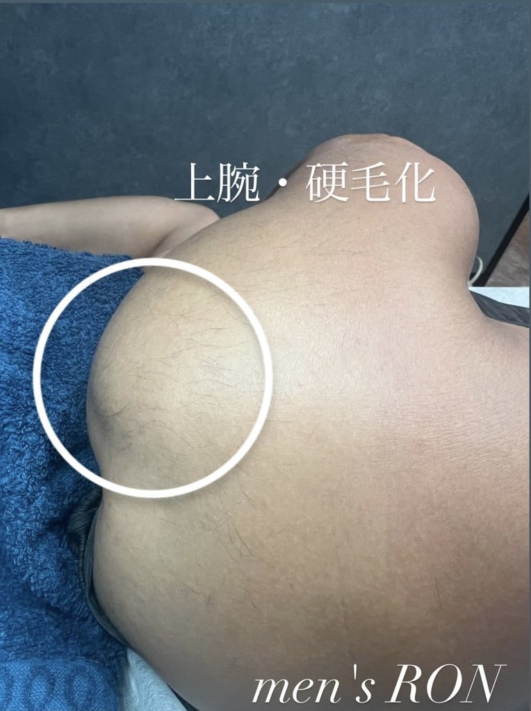 メンズ電気脱毛ron新宿 上腕の硬毛化 硬く生えてくる硬毛化してしまった毛も 1本1本着実に処理します 同じお悩みの方が 沢山ご来店されています まずはご相談ください 美容電気脱毛 メンズ脱毛ron新宿 東京都新宿区新宿2 18 5 第2成光ビル403 03 メンズ電気脱毛ron新宿 上腕の硬毛化 硬く生えてくる硬毛化してしまった毛も 1本1本着実に処理します 同じお悩みの方が 沢山ご来店されています まずはご相談ください 美容電気脱毛 メンズ脱毛ron新宿 東京都新宿区新宿2 18 5 第2成光ビル403 03
