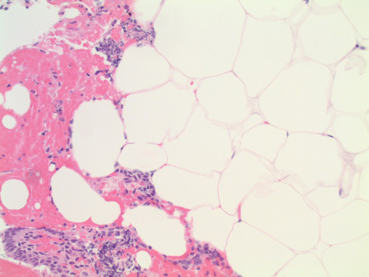 #GYNpath🧩for the #pathresidents (seasoned folks perhaps hold off a bit!):

adult F, endometrial curettage done for bleeding

🔬🧐❓
