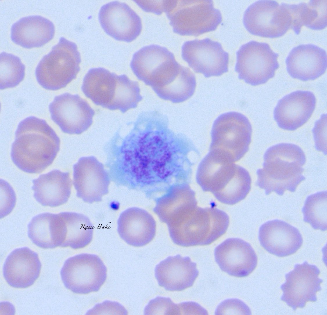 Can this giant platelet be any bigger?

You can compare its size with the two normal sized platelets next to it

#hemepath #PathTwitter #path2path #MedTwitter #hematology