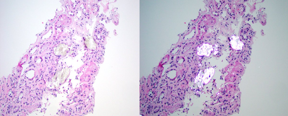 JZRenalPath's tweet photo. Pt with celiac disease and gastric bypass with AKI. Severe oxalate nephropathy and low grade IgAN. Celiac and bypass risk factors for oxalate nephropathy. Celiac also associated with IgAN. #renalpath #PathTwitter https://t.co/KBZnP7E1Yz