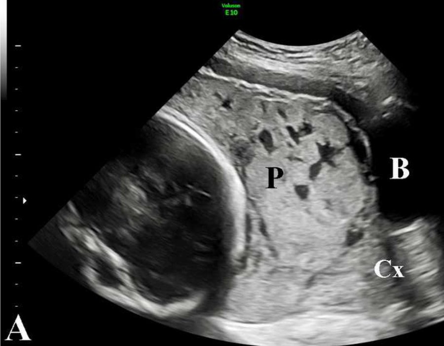 Failure of placental detachment in accreta placentation is associated with excessive fibrinoid deposition at the utero-placental interface -   ow.ly/vpCu50G00B0