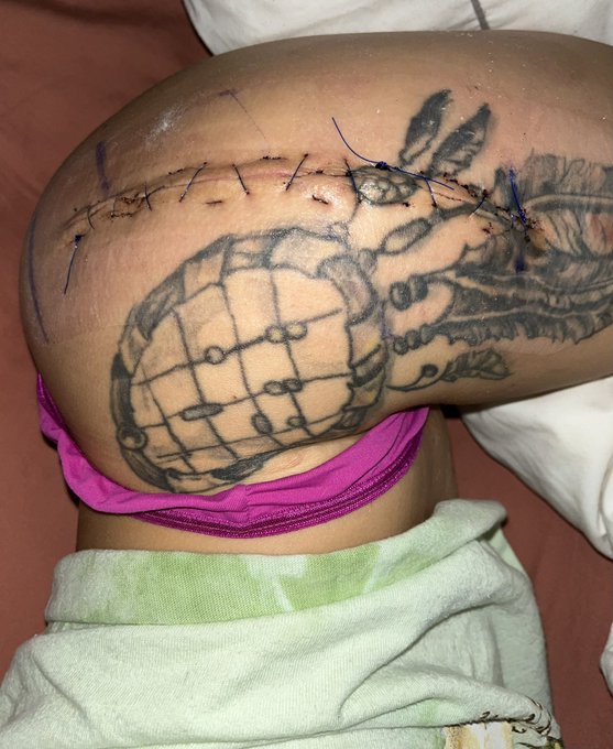 Transparent moment, say hello to my new scar. Y&rsquo;all were wondering how many tattoos I have. But I think<a href="/tag/gyho"class="tags"><span>#gyho</span></a>
