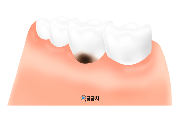 ggchi_info's tweet photo. 궁금치의 칼럼, "치경부 우식증에 대해서(원인, 단계, 치료)"이 올라왔습니다!🦷✨

https://t.co/5zGIdtXNvm https://t.co/d4Q4XdcJRY