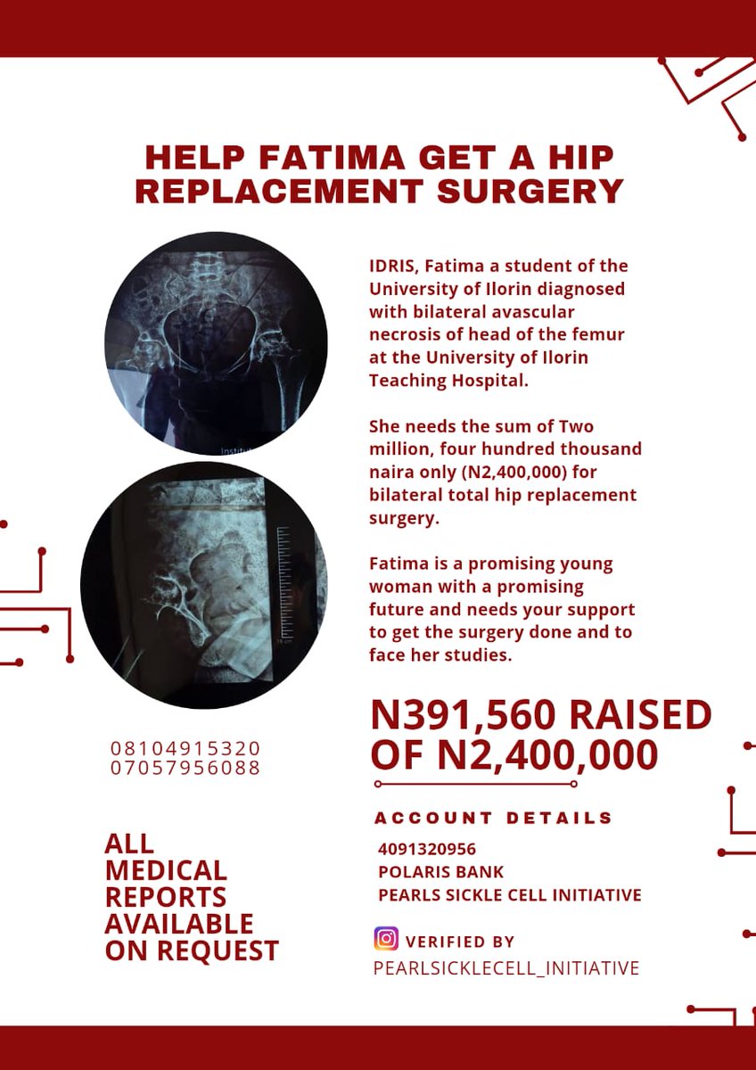 Pearls_SCF's tweet photo. IDRIS Fatima a student of the University of Ilorin diagnosed with bilateral avascular necrosis of head of the femur at the University of Ilorin Teaching Hospital.She needs the sum of Two million, four hundred thousand naira only (N2,400,000).
Please Retweet Aggressively🙏🙏 https://t.co/45DubzGT3R