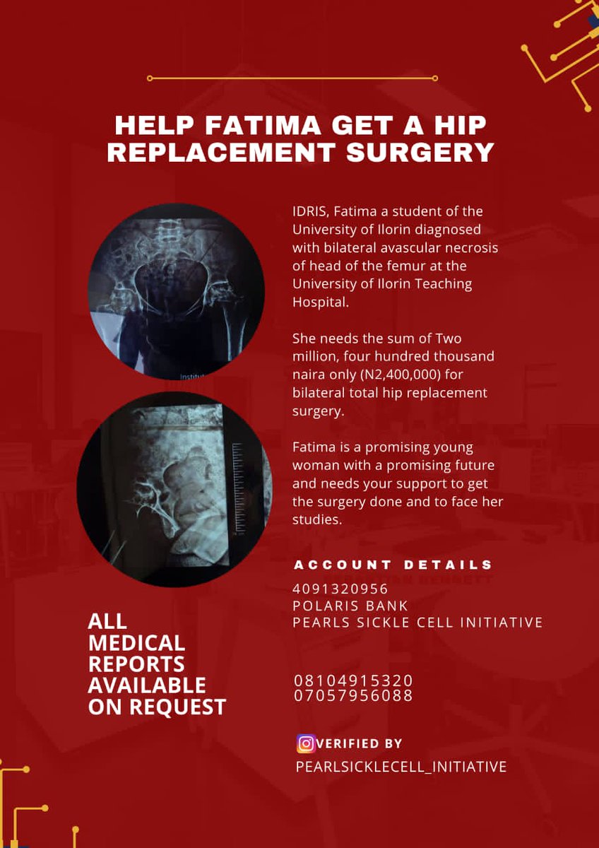 AzeezatFash's tweet photo. Please help Donate.
Help our friend, She's in pain😭🙏. Help her walk again😭.
#HelpFatima.
@aproko_doctor @wizkidayo @TemiOtedola @cuppymusic @OgbeniDipo @Davido @burnaboy
Please retweet aggressively!🙏 https://t.co/faGIeTIGv4