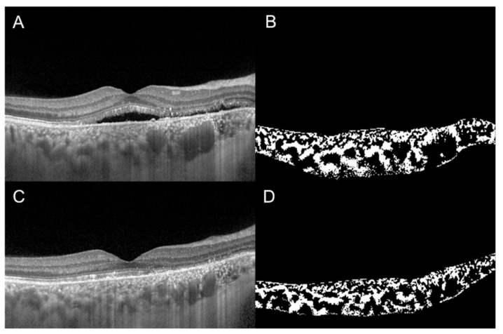 RetinaGlobal1's tweet photo. Impairment of the #choroidal vascularity index was related to the rate of geographic #atrophy enlargement at 2 years of follow-up, as per a study from #Italy.
Choroidal vascularity index may be a predictor of #GA progression.
#AMD #MacularDegeneration
Pic (c) J Clin Med https://t.co/kZnZVIqGrC