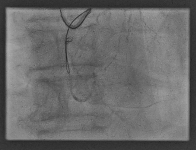 Ferrarajerome1's tweet photo. CTO learning in la Timone Hospital, Marseille. Right Coronary CTO. Controlled antegrade dissection. Reentry technique using Stingray balloon and Hornet 14. Thanks @deharo_pierre  @CuissetDr  @AntoineVaillier @SpychajC @DrThomasHovasse @PCRonline @MLCTOcourse @aphm_actu https://t.co/b2aEdwyxb7