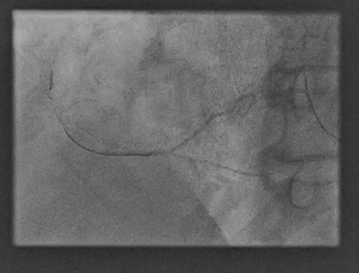 Ferrarajerome1's tweet photo. CTO learning in la Timone Hospital, Marseille. Right Coronary CTO. Controlled antegrade dissection. Reentry technique using Stingray balloon and Hornet 14. Thanks @deharo_pierre  @CuissetDr  @AntoineVaillier @SpychajC @DrThomasHovasse @PCRonline @MLCTOcourse @aphm_actu https://t.co/b2aEdwyxb7