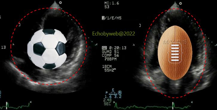 echobyweb's tweet image. New post: Transducer Position &amp;amp; LV Geometry, one of the most common pitfalls in echocardiography. 
echobyweb.com/?p=1879
#CardioTwitter #cvImaging #cvEcho #echofirst #cardiology #methodology