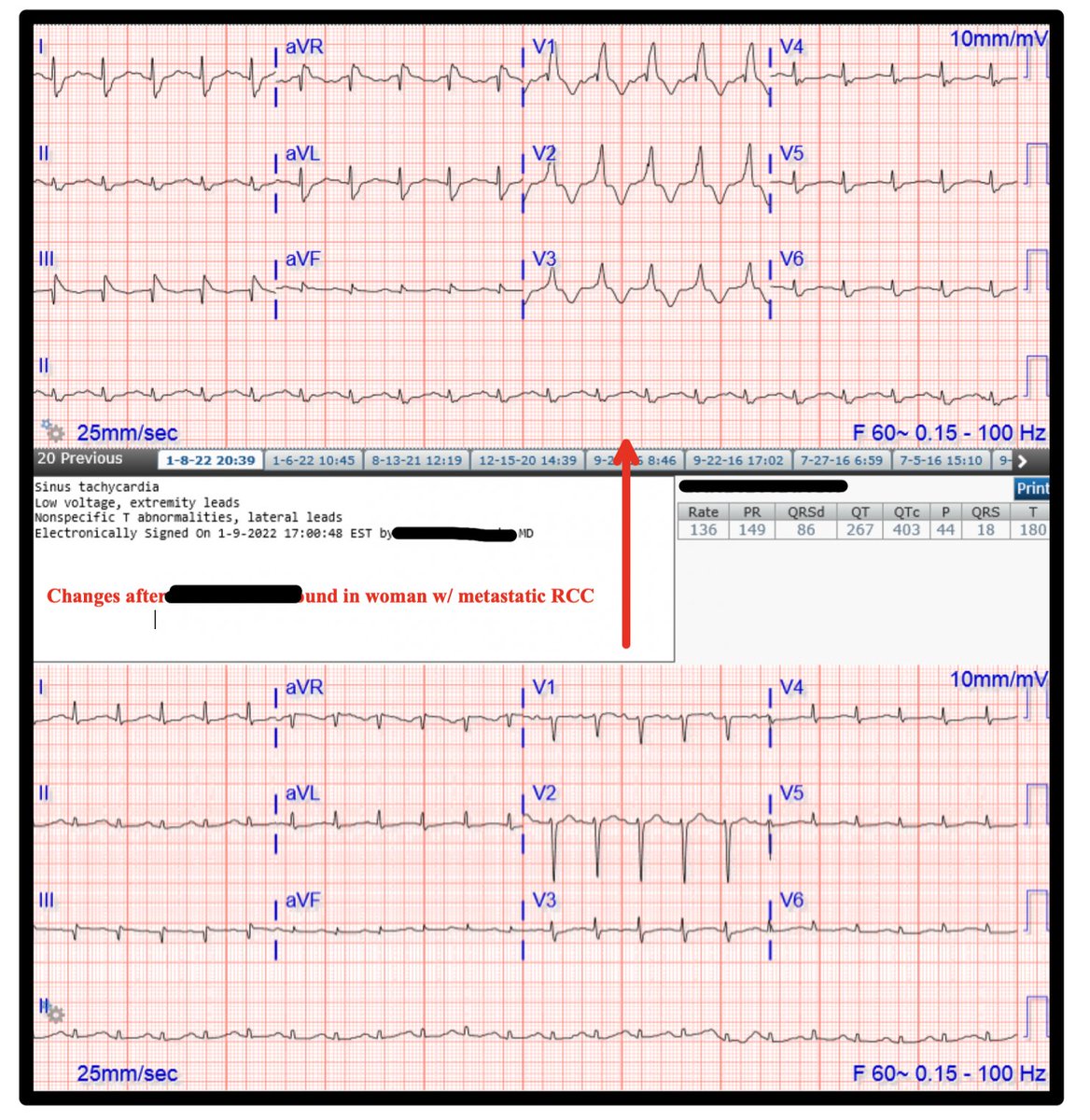 This was an ECG I saved from a woman w/ metastatic renal cell carcinoma who had acute dyspnea, tachycardia, &amp; hypoxemia while in the hospital.

What classic ECG findings are show here &amp; what test would you send next?

The bottom strip was taken 24hrs prior to the top strip!