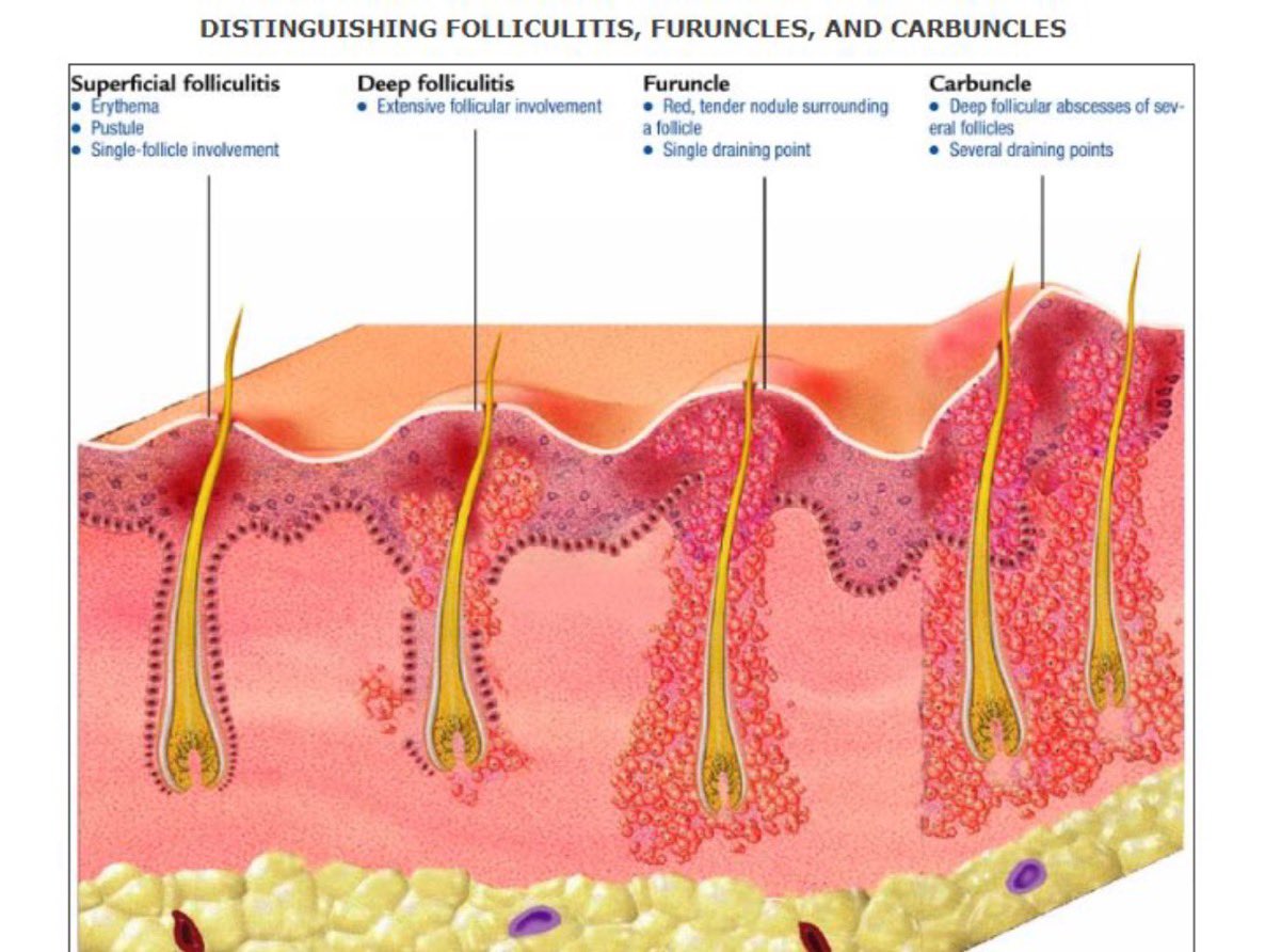 Pseudofolliculitis Barbae Prevention and Treatments – Skin Type Solutions, image size:1186x892