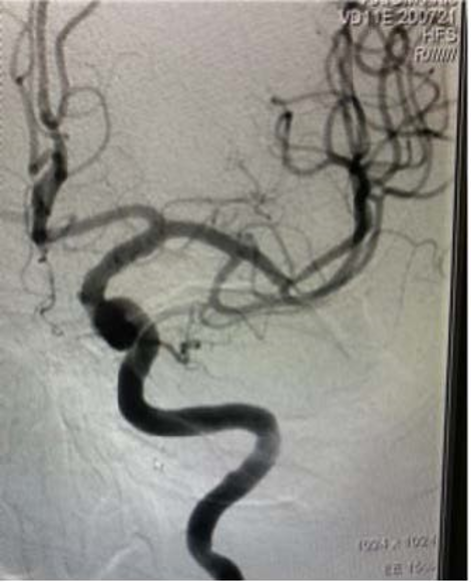PenNeuro's tweet image. US HCPs: #RED72 case by Dr. Nirav Vora out of Riverside Methodist Hospital, Ohio. #REDGlideDifference. Rx only. For risk info: bit.ly/37YcYIU. Clinical results may vary.