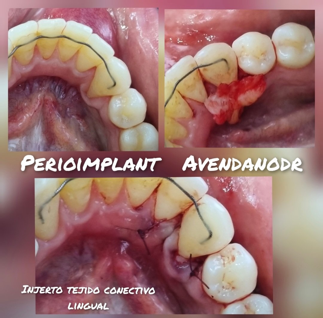 avendanodr's tweet photo. Daily Floss News 385. Injerto de tejido conectivo en recesion lingual. #mismeetteam, #misimplants, #perioimplant, #avendanodr https://t.co/Sa5uBwMrWq
