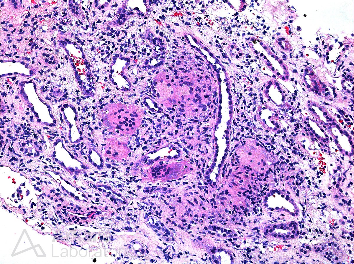 arkanalabs's tweet photo. Interestingly, granulomatous TIN has been reported in drug-naïve patients with Crohn disease. This suggests TIN may actually represent a true extraintestinal manifestation of IBD in certain patients. #DiseaseWeek

https://t.co/sWEiAIedF5 https://t.co/NDAK3V0NYR