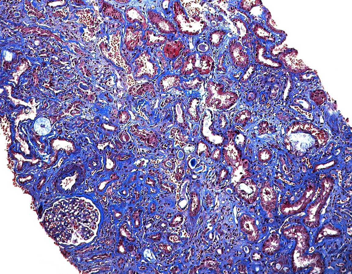 arkanalabs's tweet photo. Interestingly, granulomatous TIN has been reported in drug-naïve patients with Crohn disease. This suggests TIN may actually represent a true extraintestinal manifestation of IBD in certain patients. #DiseaseWeek

https://t.co/sWEiAIedF5 https://t.co/NDAK3V0NYR