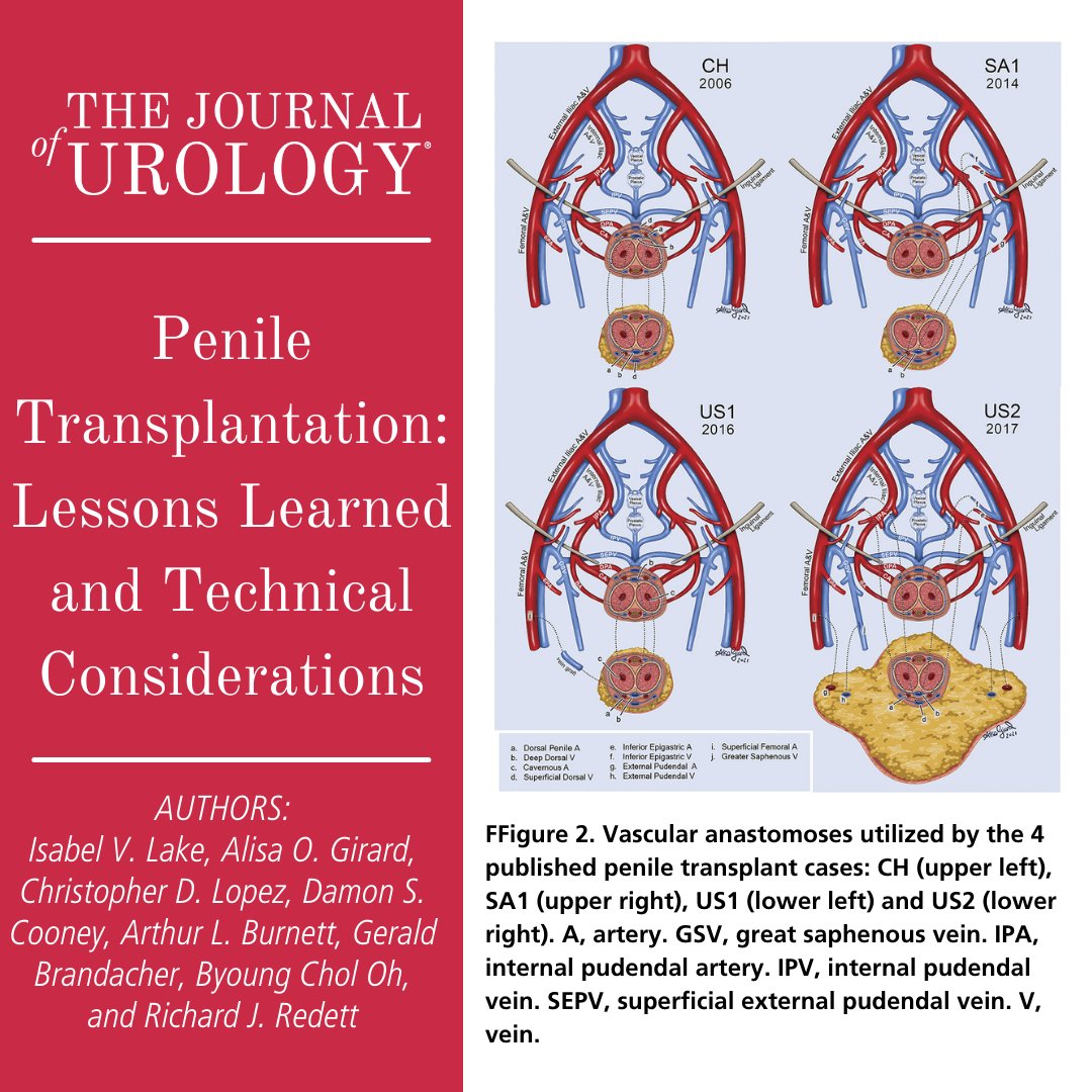 JUrology's tweet photo. "Penile Transplantation: Lessons Learned and Technical Considerations" #UroSoMe
➡️https://t.co/zPt48InCVu

By: Isabel V. Lake, Alisa O. Girard, @cd_lopez_, Damon S. Cooney, Arthur L. Burnett, Gerald Brandacher, Byoung Chol Oh, and Richard J. Redett https://t.co/wjlJflOIlT