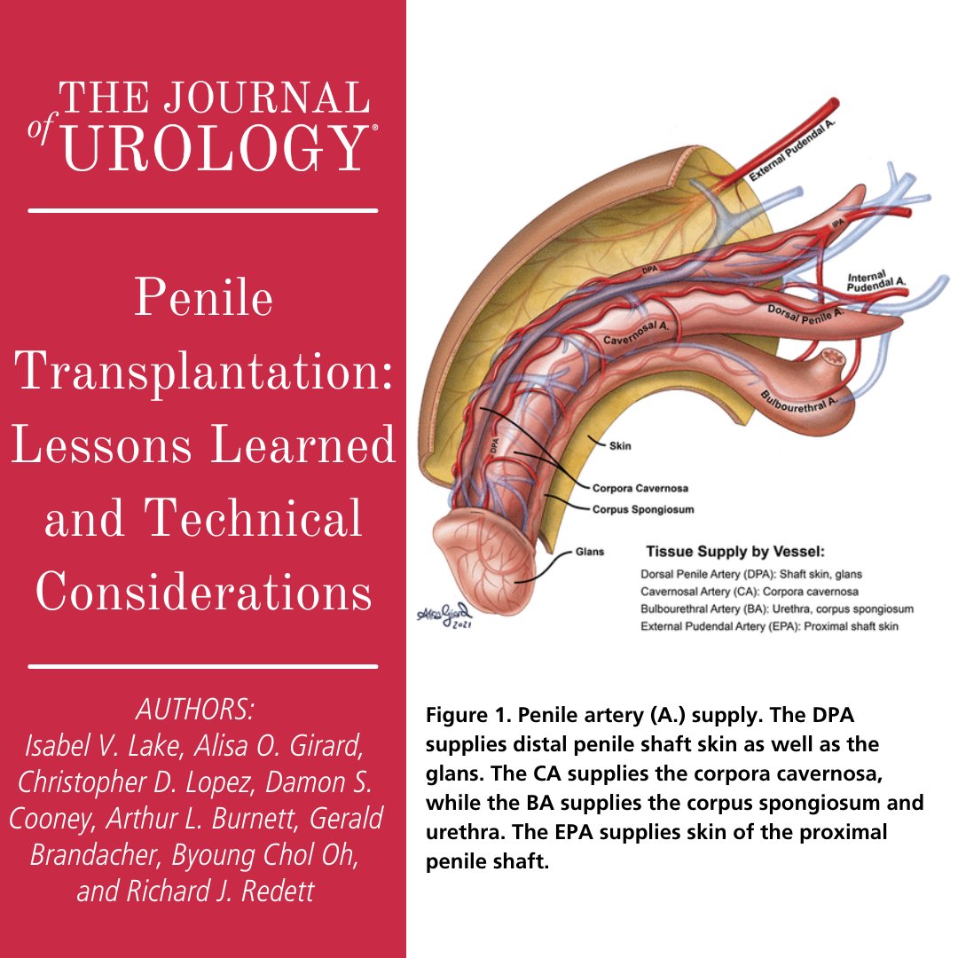 JUrology's tweet photo. "Penile Transplantation: Lessons Learned and Technical Considerations" #UroSoMe
➡️https://t.co/zPt48InCVu

By: Isabel V. Lake, Alisa O. Girard, @cd_lopez_, Damon S. Cooney, Arthur L. Burnett, Gerald Brandacher, Byoung Chol Oh, and Richard J. Redett https://t.co/wjlJflOIlT