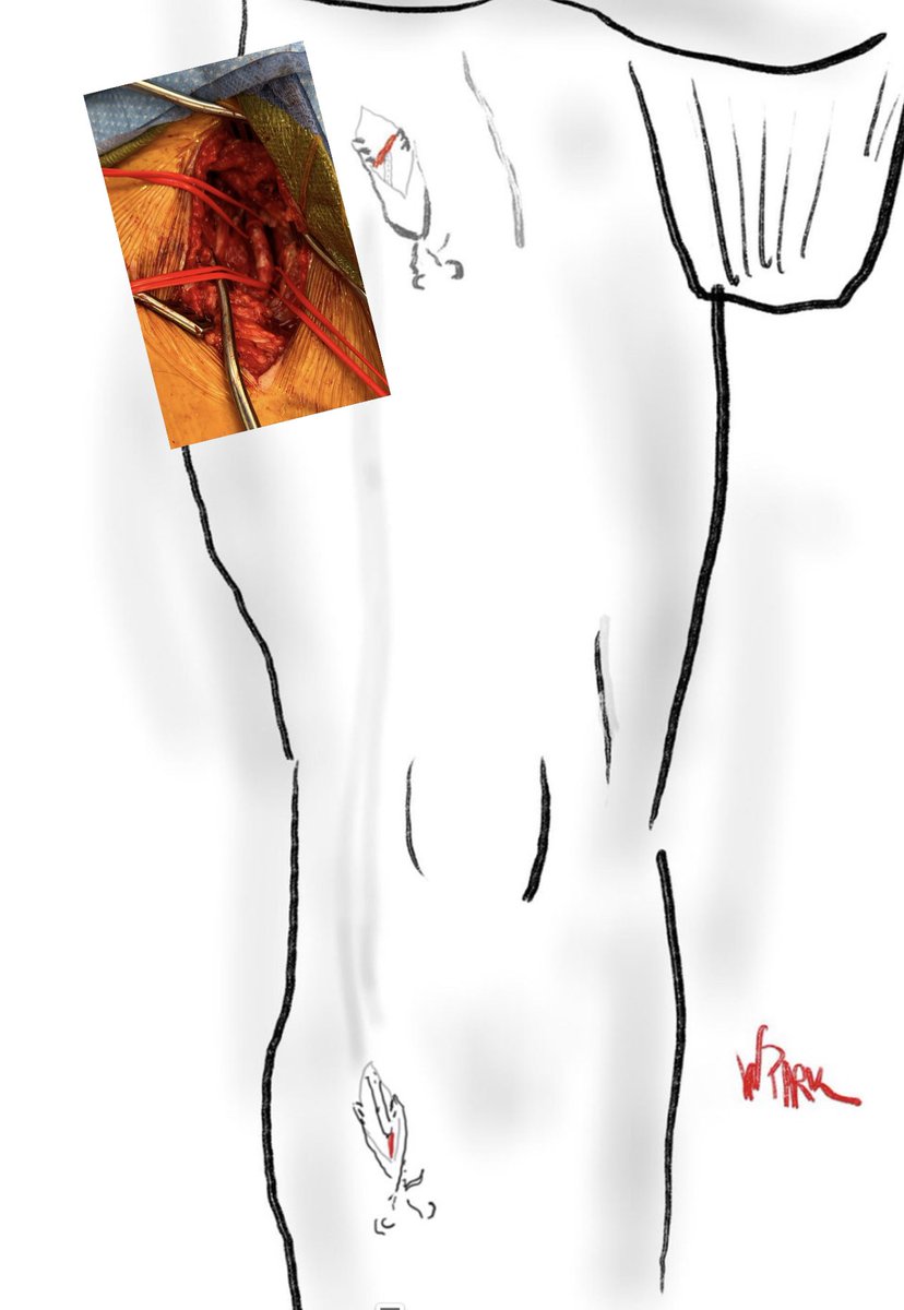 limbsalvagedr's tweet photo. Hopefully I did @docpark gorgeous drawing justice! #lateralapproach #profundaisking #vasctwitter https://t.co/gD7GTfniee