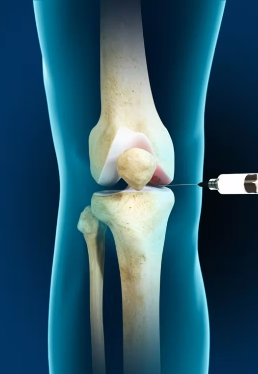 jbjs's tweet photo. Updated #JBJSClinicalSummary on #Intra-articular Injections for #Nonoperative Management of #Knee #Osteoarthritis
By: Lisa C. Howard, MD, FRCSC and Bassam A. Masri, MD, FRCSC
https://t.co/9nnP5p9FEt https://t.co/FTW8xOLA2l