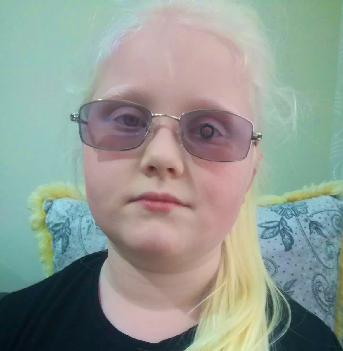 azgorme's tweet photo. Hey friends, you're missing out some great information about World’s only invisible special telescopic #spectacle. 

#Blindness &amp; #LowVision are out now w/#MiniTelescopicGlasses 
You can reach a visual acuity up to driving level with my glasses 

Check out https://t.co/N6xH0WVTFx https://t.co/04hCJN2x7w