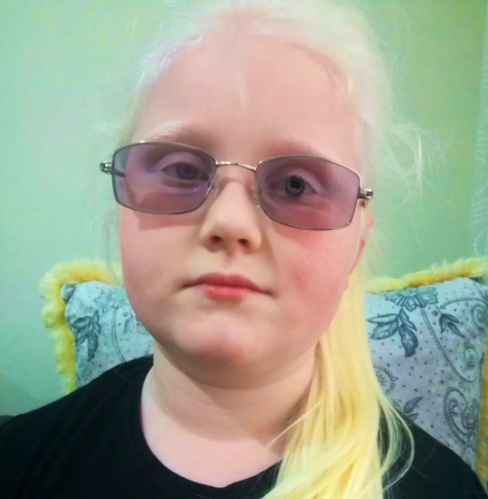 azgorme's tweet photo. Hey friends, you're missing out some great information about World’s only invisible special telescopic #spectacle.
#stargarts #albinism #Opticatrophy #conedystrophy #macula are out now w/#MiniTelescopicGlasses
You can reach a visual acuity up to driving level with my glasses https://t.co/2IVnYEuWcn