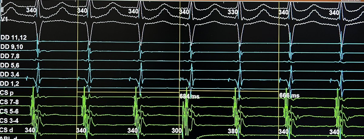 Roderick Tung (@drrodericktung) on Twitter photo Picked this maneuver up from John Miller this weekend! Lifelong learning from those with more experience is the beautiful thing about EP.
Late PAC resets AVNRT from CS 1,2 but not 9,10. Proof of left-sided input after failed right sided slow pathway RF. <a href="/StavrosStavrak1/">Stavros Stavrakis</a> et al👇 Picked this maneuver up from John Miller this weekend! Lifelong learning from those with more experience is the beautiful thing about EP.
Late PAC resets AVNRT from CS 1,2 but not 9,10. Proof of left-sided input after failed right sided slow pathway RF. <a href="/StavrosStavrak1/">Stavros Stavrakis</a> et al👇