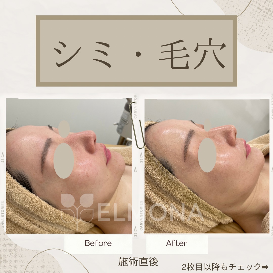 グリーンピール専門店 エルモナ 元祖ハーブピーリング Elmona Green Twitter