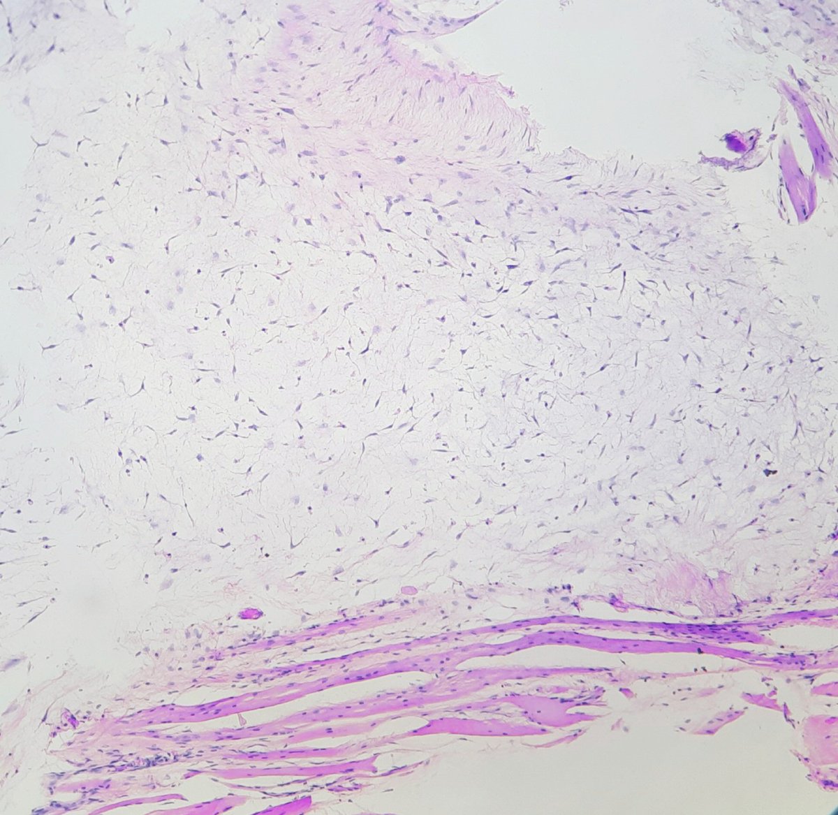 pathognosis22's tweet photo. #Case23 Intramuscular myxoma: hypocellular tumor with bland spindle cells and few focal blood vessel, mild nuclear atypia focally, no necrosis/mitosis, IHC: AR pos/ S100,SOX10 neg #pathology #bstpath #bst #pathtwitter #pathworld #pathart https://t.co/nWqhaq9vb9