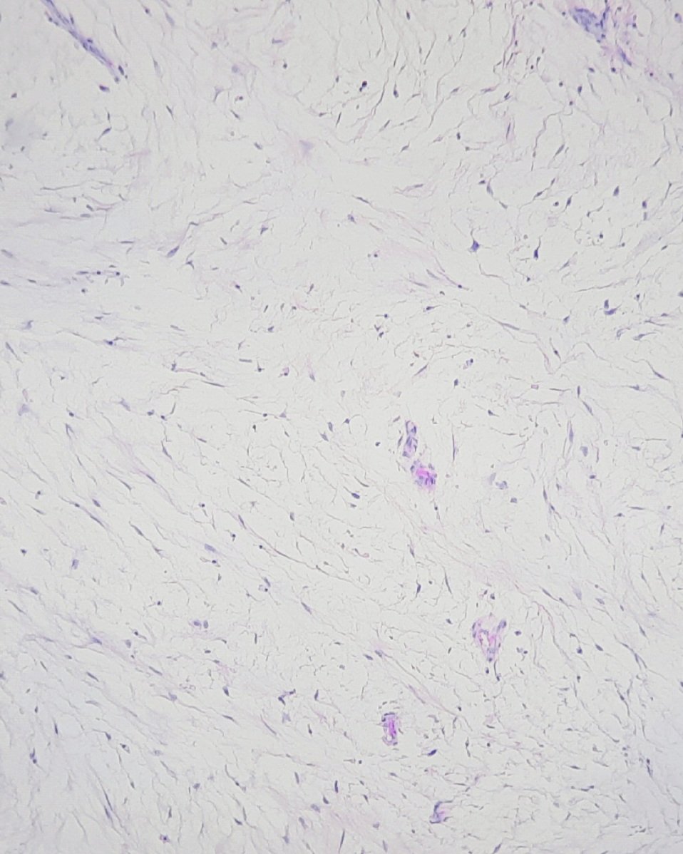 pathognosis22's tweet photo. #Case23 Intramuscular myxoma: hypocellular tumor with bland spindle cells and few focal blood vessel, mild nuclear atypia focally, no necrosis/mitosis, IHC: AR pos/ S100,SOX10 neg #pathology #bstpath #bst #pathtwitter #pathworld #pathart https://t.co/nWqhaq9vb9