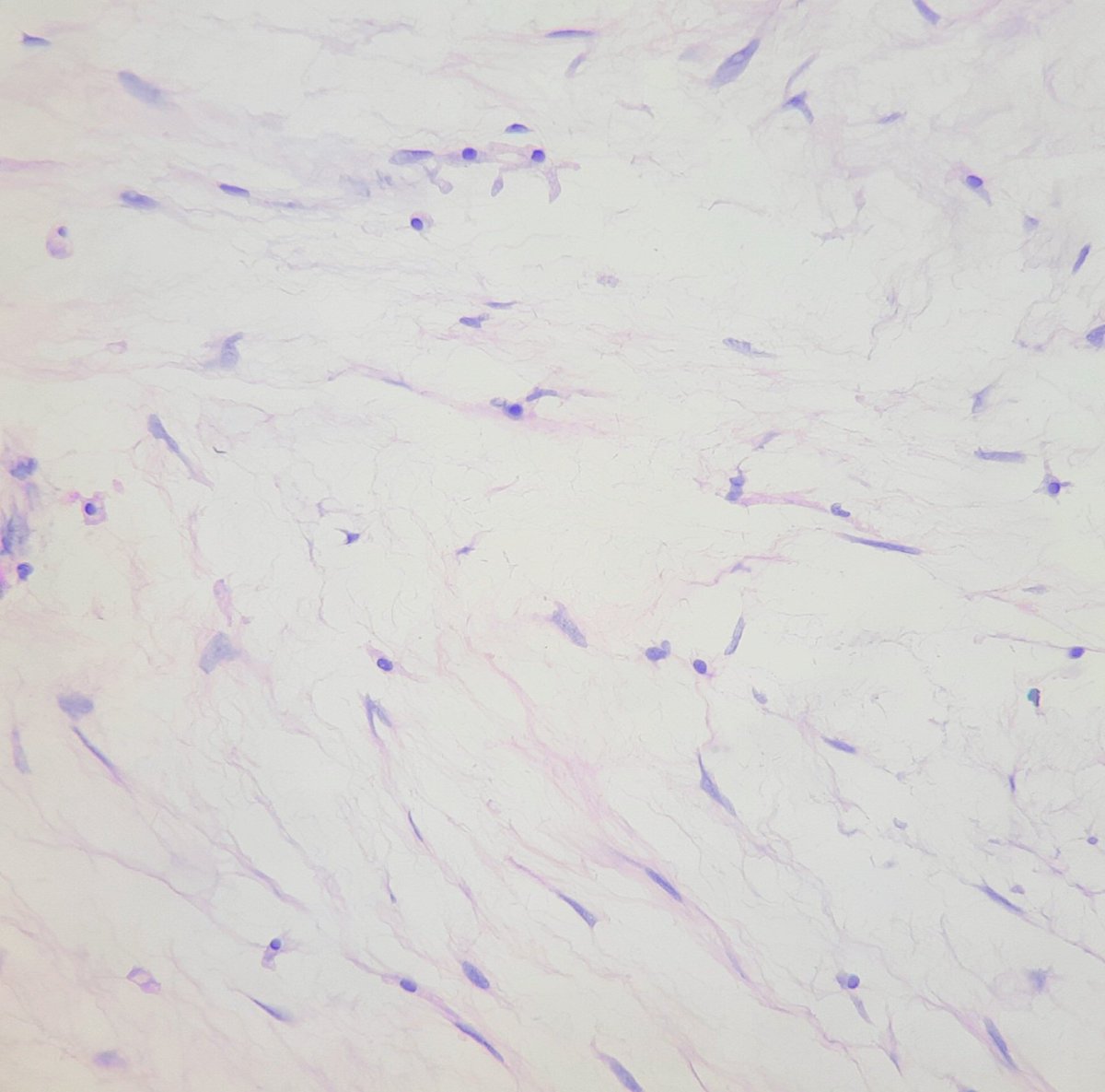 pathognosis22's tweet photo. #Case23 Intramuscular myxoma: hypocellular tumor with bland spindle cells and few focal blood vessel, mild nuclear atypia focally, no necrosis/mitosis, IHC: AR pos/ S100,SOX10 neg #pathology #bstpath #bst #pathtwitter #pathworld #pathart https://t.co/nWqhaq9vb9