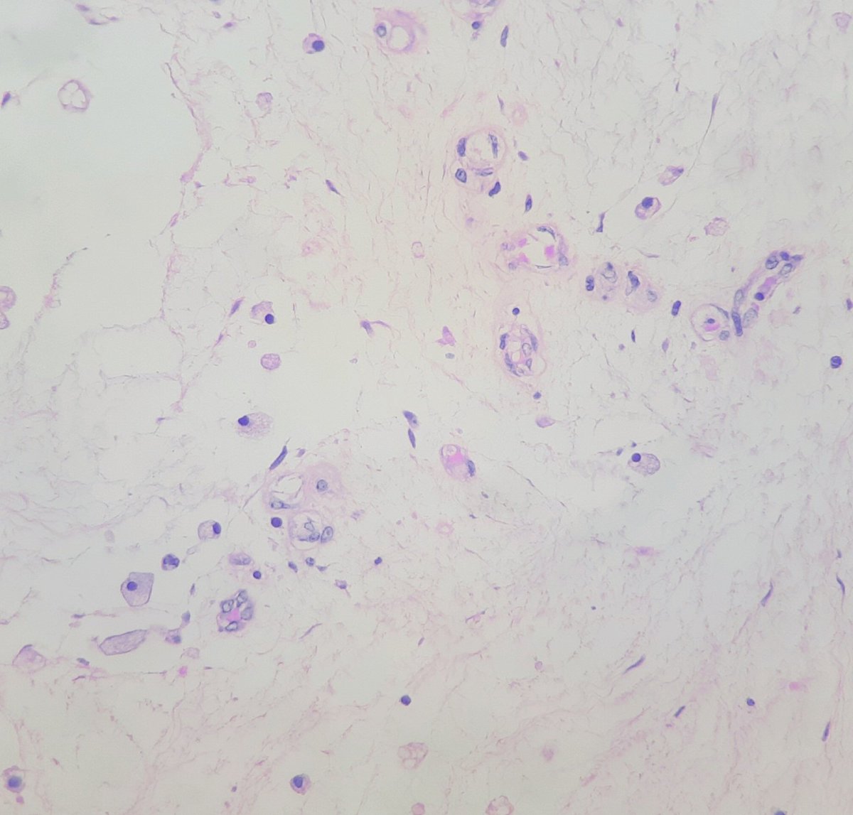 pathognosis22's tweet photo. #Case23 Intramuscular myxoma: hypocellular tumor with bland spindle cells and few focal blood vessel, mild nuclear atypia focally, no necrosis/mitosis, IHC: AR pos/ S100,SOX10 neg #pathology #bstpath #bst #pathtwitter #pathworld #pathart https://t.co/nWqhaq9vb9