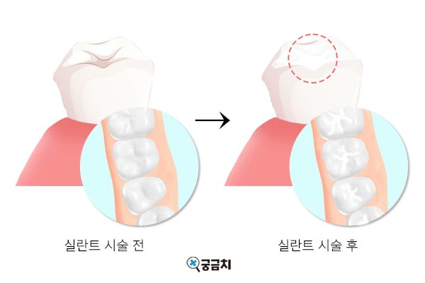ggchi_info's tweet photo. 궁금치의 칼럼, "소아 영구치 홈메우기(실란트)가 어려운 이유"가 올라왔습니다!🦷✨

https://t.co/EHcGlYszKe https://t.co/lfZ01FFkYW