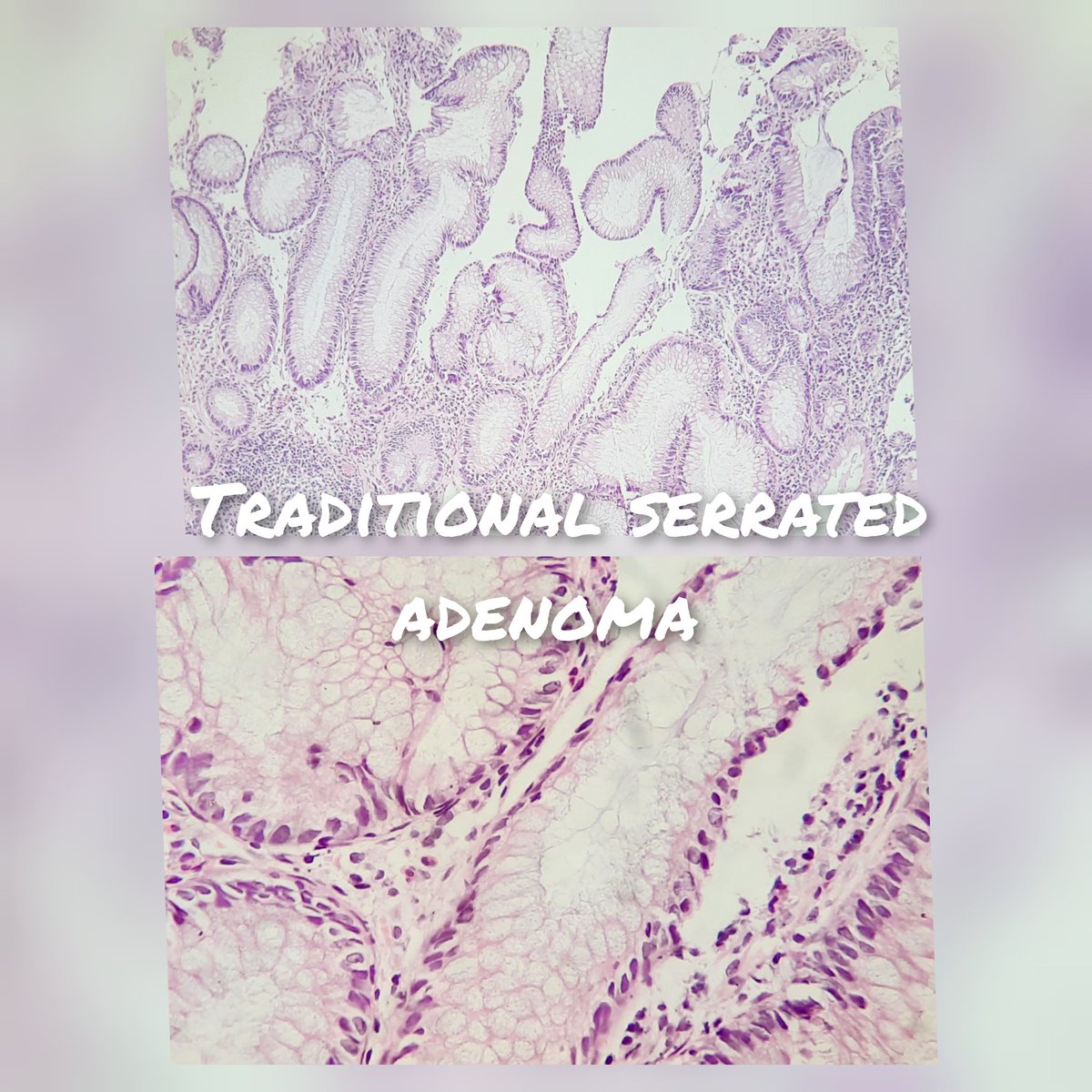 pathognosis22's tweet photo. #Case16 3 in one !
Tubular adenoma: picket fence nuclei /pencillate/pseudostratified,h/c nuclei showing low grade dysplasia
Sessile* hyperplastic polyp showing elongated crypts lined by non-dysplastic epithelium
TSA: Complex crypt/ectopic/L shape with low gr dysplasia #path https://t.co/aHq7fWyIkL