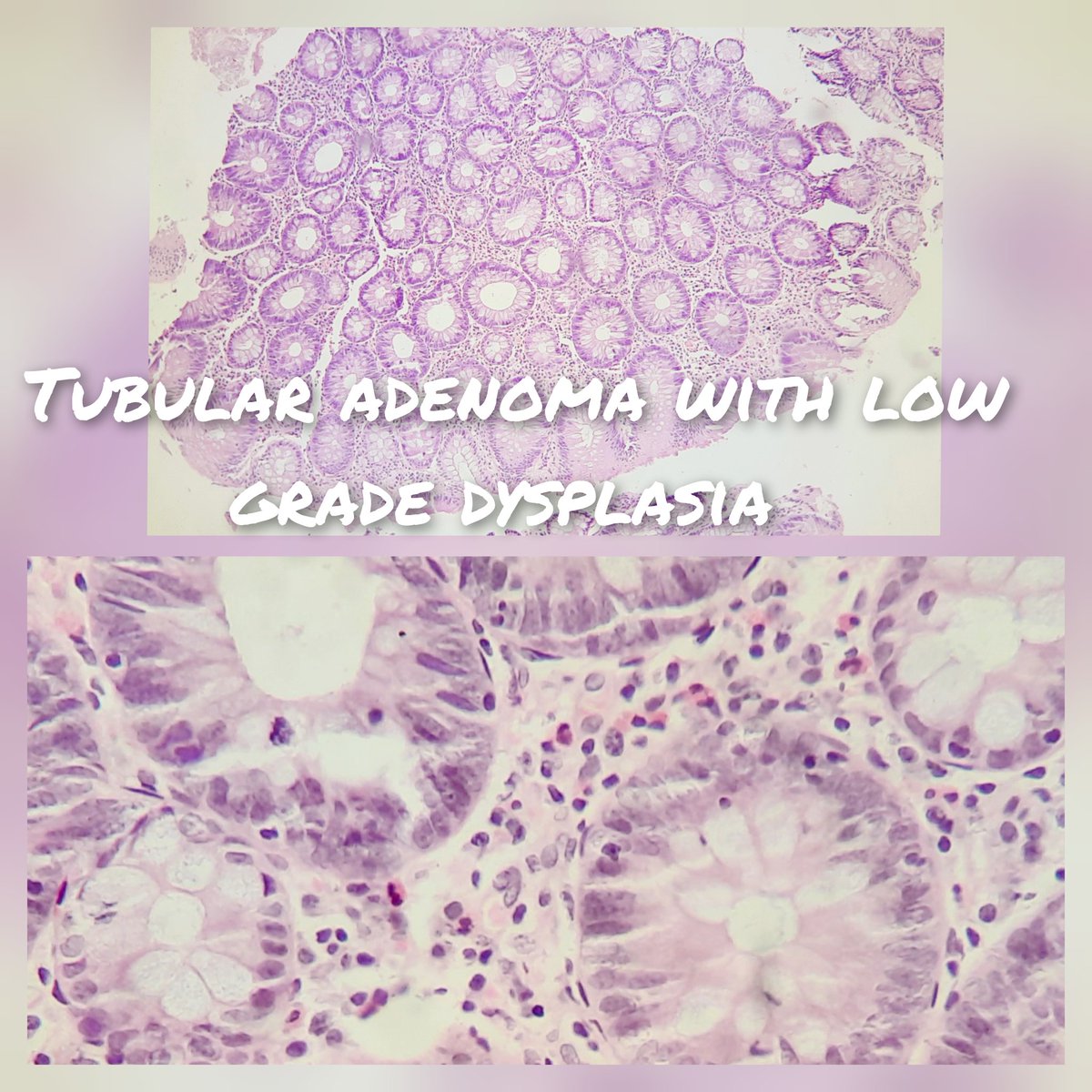 pathognosis22's tweet photo. #Case16 3 in one !
Tubular adenoma: picket fence nuclei /pencillate/pseudostratified,h/c nuclei showing low grade dysplasia
Sessile* hyperplastic polyp showing elongated crypts lined by non-dysplastic epithelium
TSA: Complex crypt/ectopic/L shape with low gr dysplasia #path https://t.co/aHq7fWyIkL