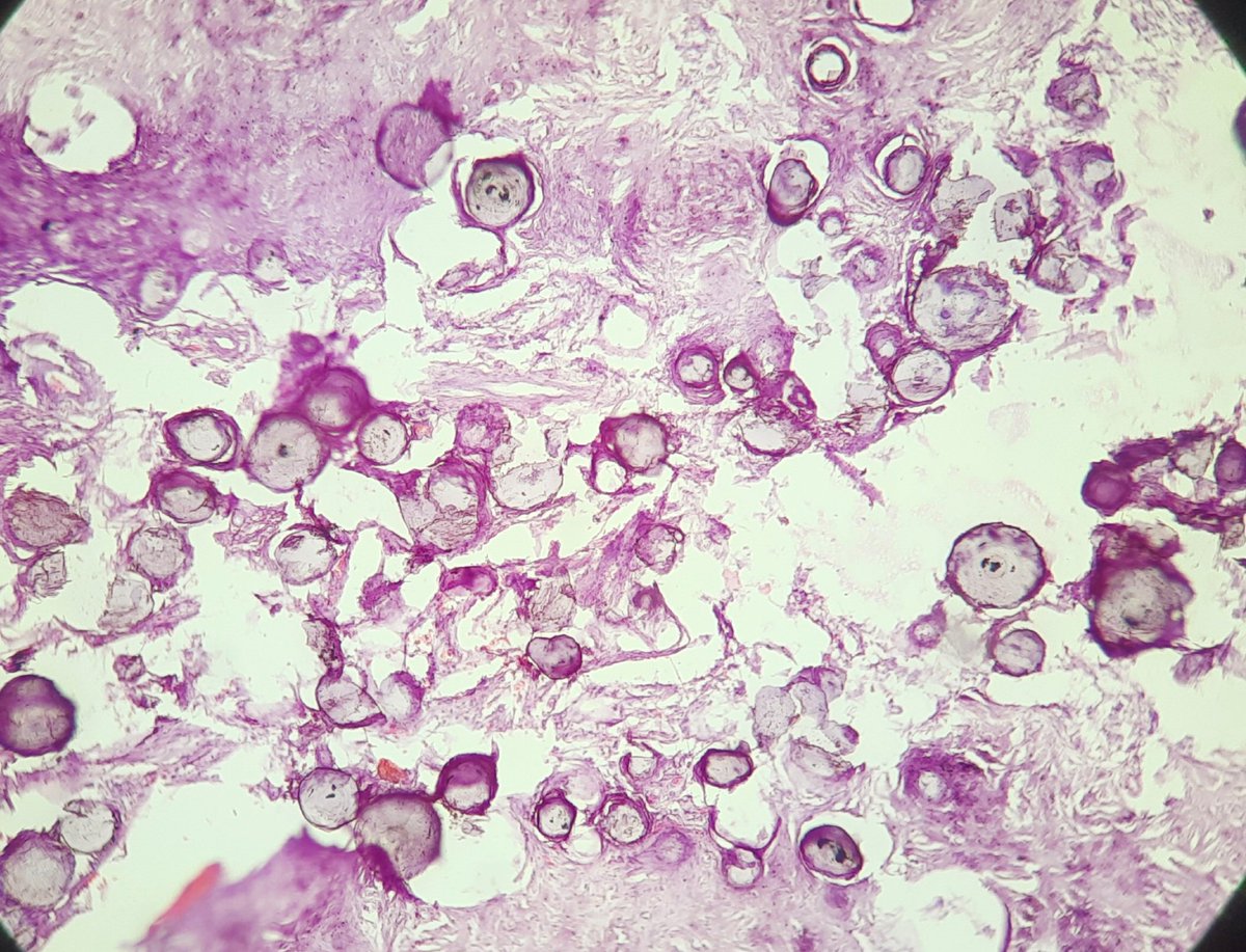 pathognosis22's tweet photo. #Case17 2 in 1 !
Psamommatous meningioma! with schwannoma ( look at the verocay bodies! ) #pathart #pathology #path #Artinpathology #neuropath #pathmcq https://t.co/LT6eR8AyCR