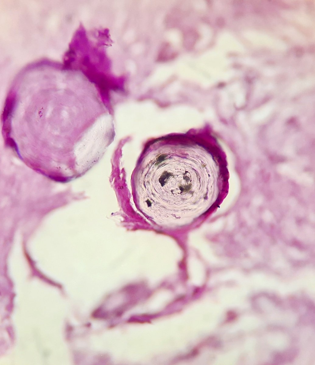 pathognosis22's tweet photo. #Case17 2 in 1 !
Psamommatous meningioma! with schwannoma ( look at the verocay bodies! ) #pathart #pathology #path #Artinpathology #neuropath #pathmcq https://t.co/LT6eR8AyCR