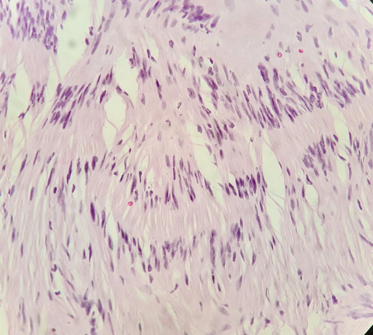 pathognosis22's tweet photo. #Case17 2 in 1 !
Psamommatous meningioma! with schwannoma ( look at the verocay bodies! ) #pathart #pathology #path #Artinpathology #neuropath #pathmcq https://t.co/LT6eR8AyCR
