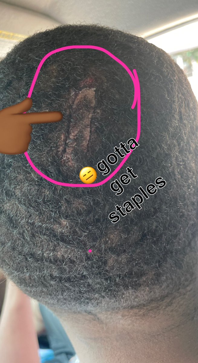 So I got bit in the head hooping 🙄
#Ballislife #crazy #wtf #how