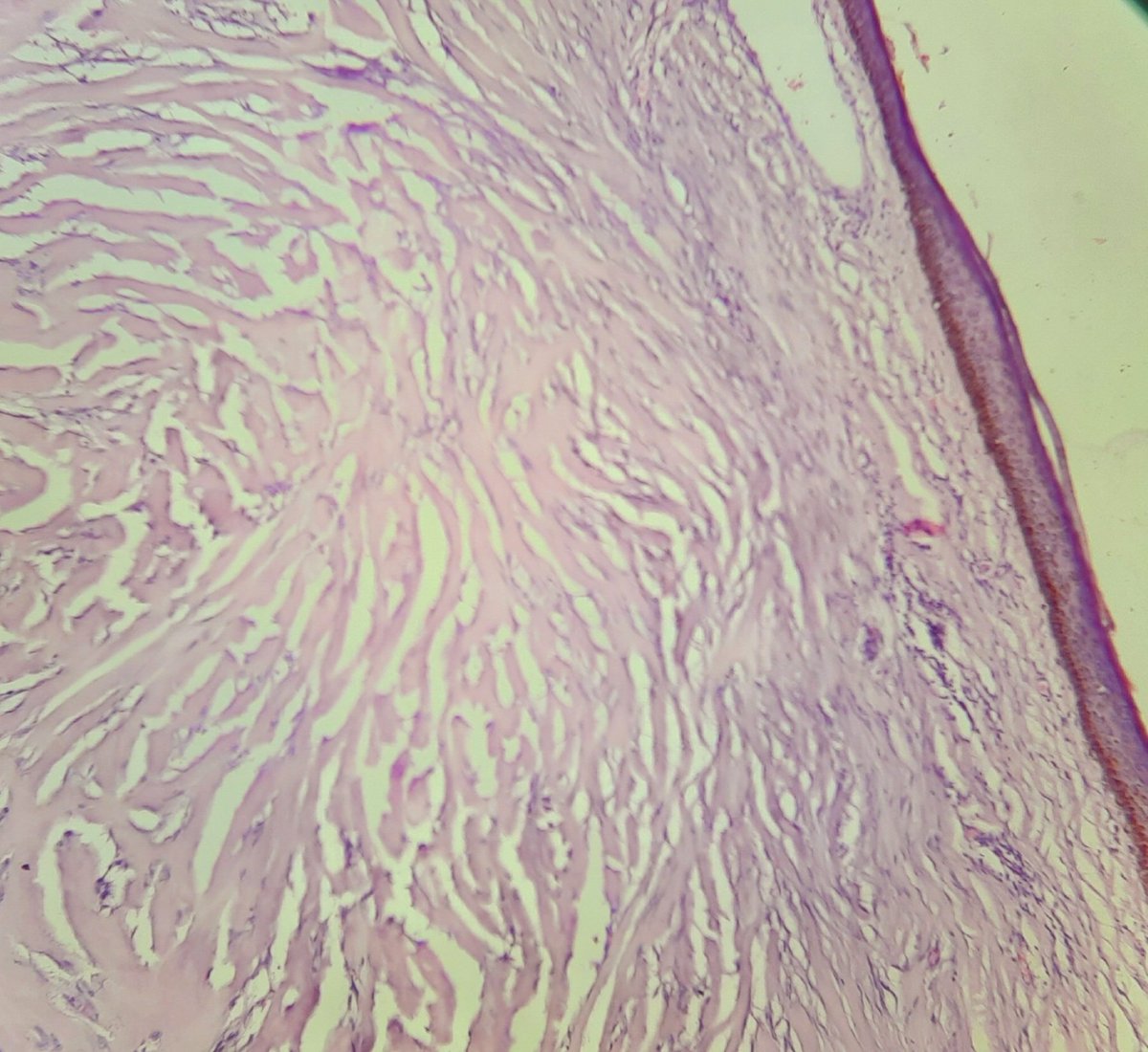 pathognosis22's tweet photo. #Case24 Keloid: parallel collagen bundles ( steroid injection-> mucin pool ) DD: Hyperplastic scar: haphazard edematous collagen bundles #pathart #dermapath #dermatology #pathology #pathmcq https://t.co/ULRsDML15U