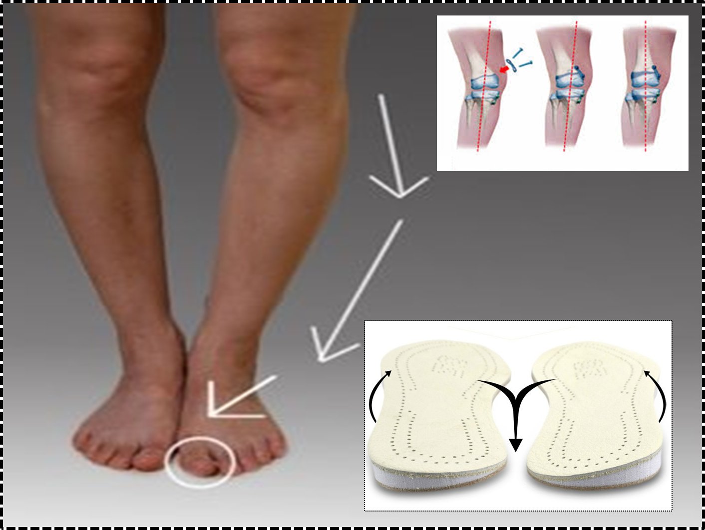 My Care Prosthetics and Orthotics on Twitter "Mermaid Splint for bow